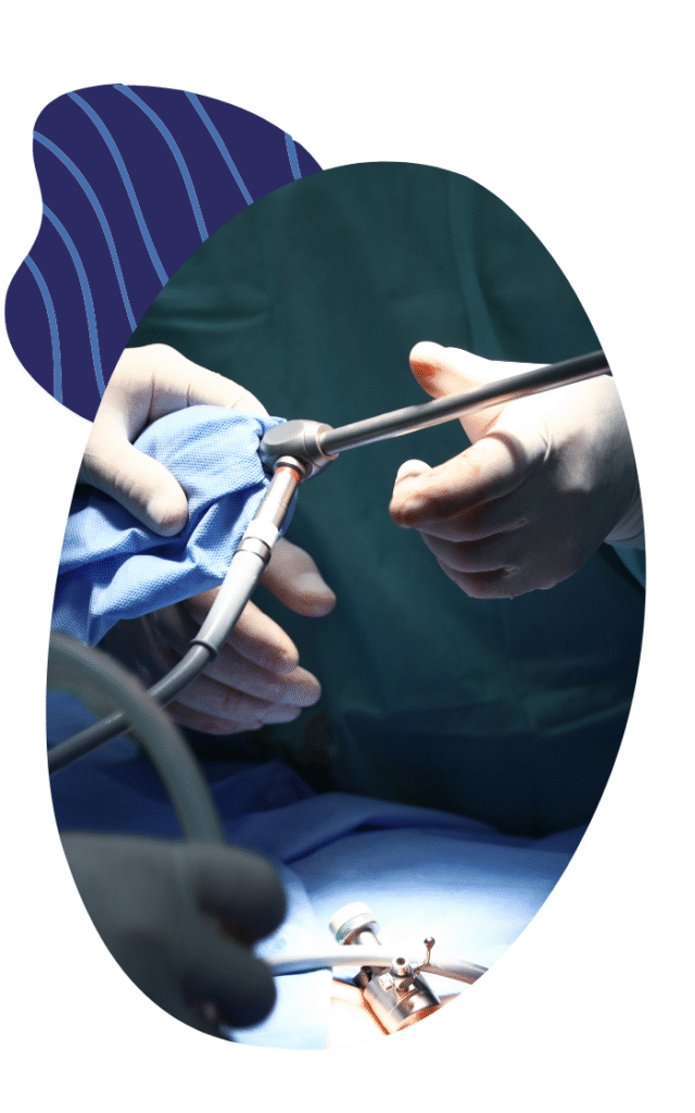 Laparoscopy